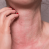 Allergies